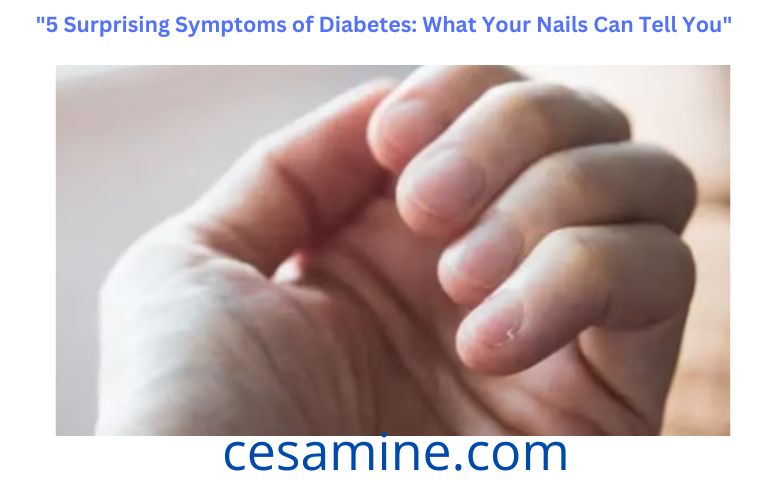 5 Surprising Symptoms of Diabetes What Your Nails Can Tell You