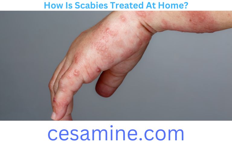 How Is Scabies Treated At Home