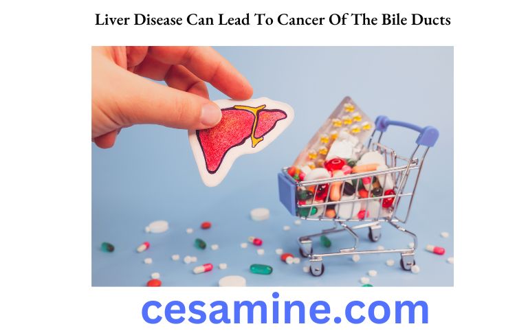 Liver Disease Can Lead To Cancer Of The Bile Ducts