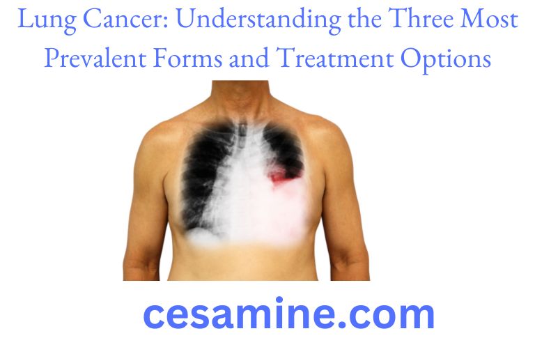 Lung Cancer Understanding the Three Most Prevalent Forms and Treatment Options