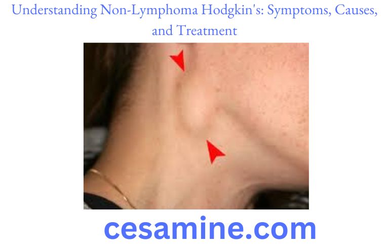 Understanding Non-Lymphoma Hodgkin's